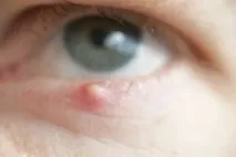Ячмінь на оці до якого лікаря звертатися, лікування чи операція якого