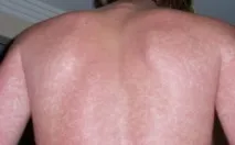 алергия алергична реакция