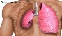 астматичний
