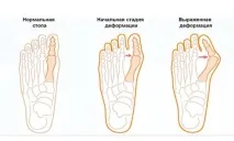 бурсит стъпалото