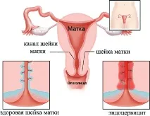 Цервіцит та ендоцервіцит шийки матки, що це таке таке