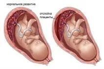 Відшарування плаценти на ранніх та пізніх термінах вагітності, причини, симптоми, лікування пізніх