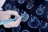 Що таке хворобаПаркінсона, Довідка, Питання-Відповідь, Аргументи та Факти таке