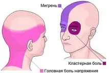 Що таке мігрень симптоми та лікування, причини виникнення таке