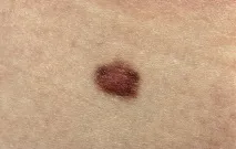 невус невус