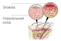 Дієта та лікувальне харчування при екземі меню, рецепти, відгуки лікарів екземі