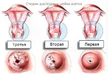 дисплазия шийка