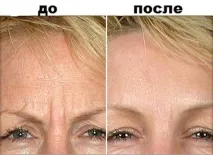 Диспорт усунення зморшок та зморшок зморшок