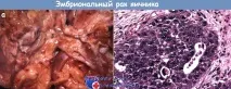 ембрионален яйчниците