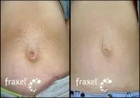 Фракційний лазер Fraxel - Fraxel ВИДАЛЕННЯ РОЗТЯЖОК fraxel