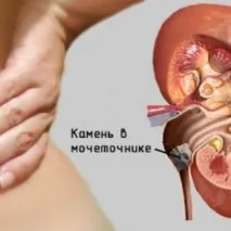 Гнійне запалення нирок прояви, причини та методи рятування нирок