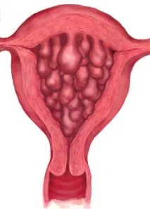 Hiperplazia endometrială ce este - Răspunsuri și sfaturi