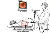 методи червата