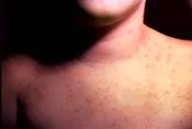 може бъде пиелонефрит