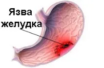 Кал із кров’ю після алкоголю як ознака патологічних процесів кров