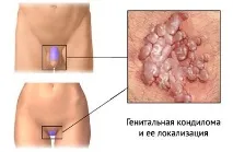 кондиломи гениталиите