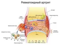 компреси артрит