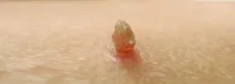 лечение кондиломи