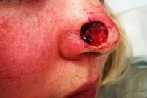 лечение кожен