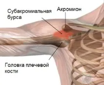 лечение рамо