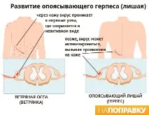 симптоми постхерпетична невралгия