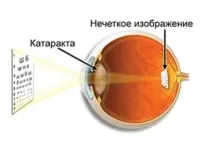 Операція із заміни кришталика очі протипоказання, показання, поради кришталика