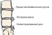 Особливості прояву та лікування гриж поперекового відділу хребта (л3-л4, л4-л5, л5-с1) гриж
