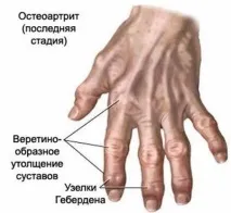 Остеоартроз кистей рук стадії, симптоми, лікування препаратами та народними засобами лікування