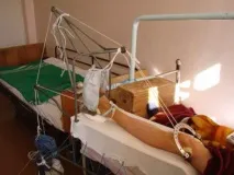 Перелом кісток тазу та перша допомога при травмі перелом