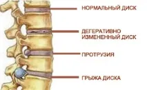 херния херния