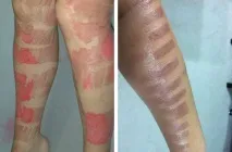 горещо петите