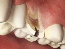 притискането след