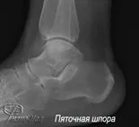 П’яткова шпора фото та ціна, ЗНИЖКИ АКЦІЇ знижки