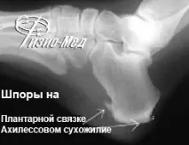 П’яткова шпора фото та ціна, ЗНИЖКИ АКЦІЇ яткова