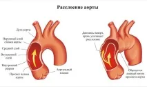 дисекция симптоми
