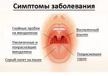 ангина ангина