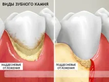 плака зъбната