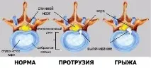 Сколіоз 4 ступеня - симптоми та лікування ступеня
