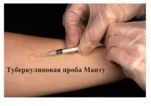 манту туберкулинов тест