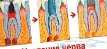 зъбен нерв