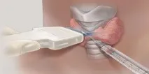 Вузловий зоб причини появи та схема лікування захворювання у 2019 році схема