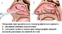 гайморит