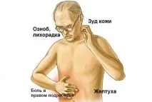 Холестаз причини, симптоми та лікування захворювання лікування