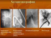 Холестаз причини, симптоми та лікування захворювання симптоми