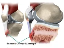Всі факти про хворобу Осгутта Шляттера кістки