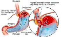 причинява рефлукс