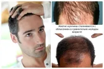 Андрогенетична алопеція, Клініка"Арсмед" арсмед