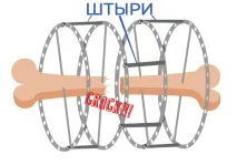 Апарат Ілізарова ілізарова