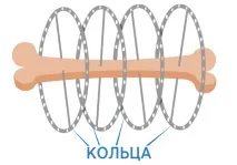 Апарат Ілізарова років
