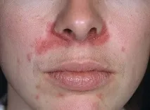 алергичен лицето